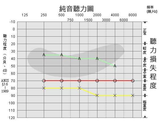 纯音测试图怎么看[纯音测试结果怎么看]