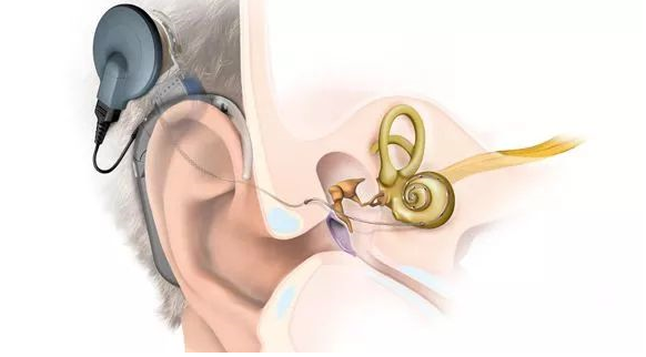 美国人工耳蜗介绍-美国人工耳蜗官网