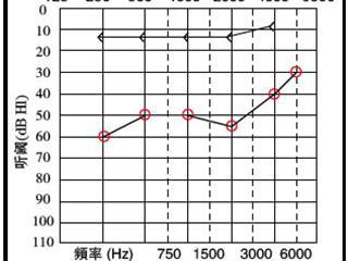 助听器能恢复听力吗